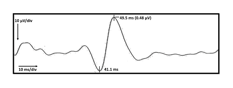 Axis Distal Stimulation.png (50 KB)