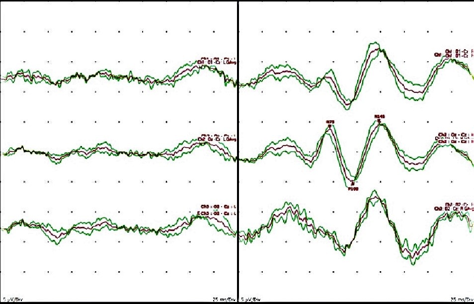 Fig 2. VEP