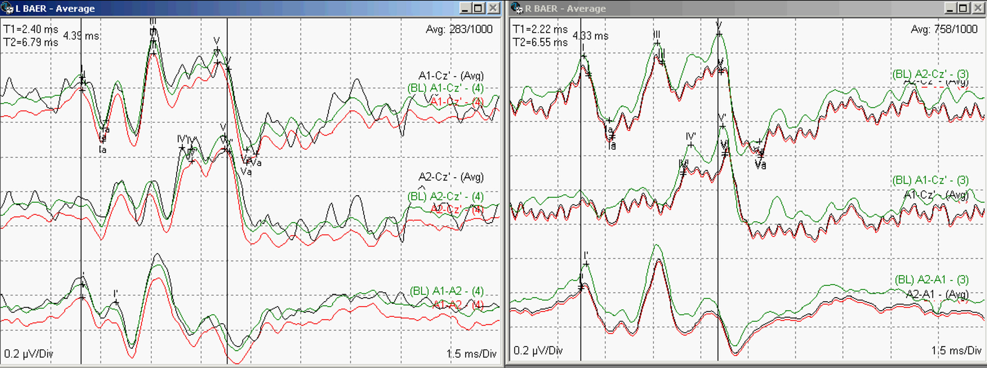 Fig 4. BAEP