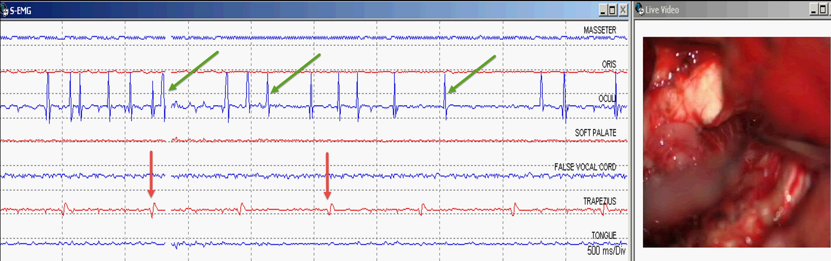 Fig 6. Lower CN EMG