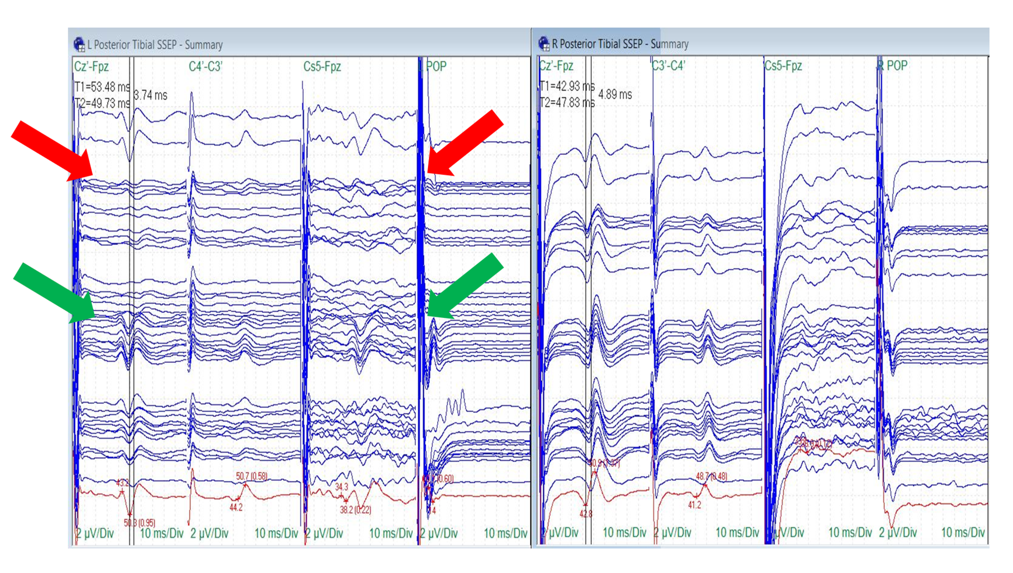 article_river_52ee99f0b04911e884022370c1cb02af-Fig-7.-SSEP-PTN-Changes