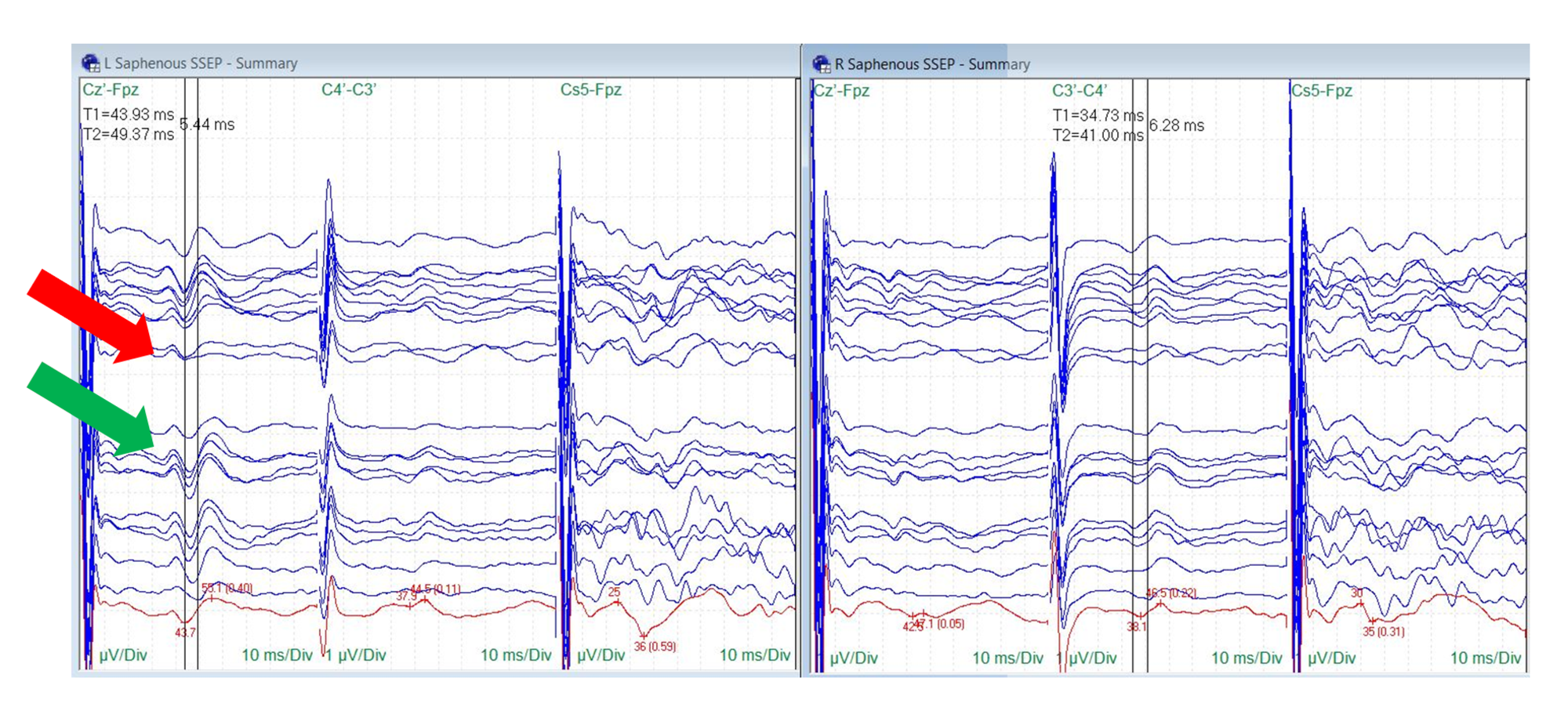 article_river_a1253bf0b2ca11e8a77aa5517754acf8-Fig-8.-SSEP-Saphaneous-nerve-changes