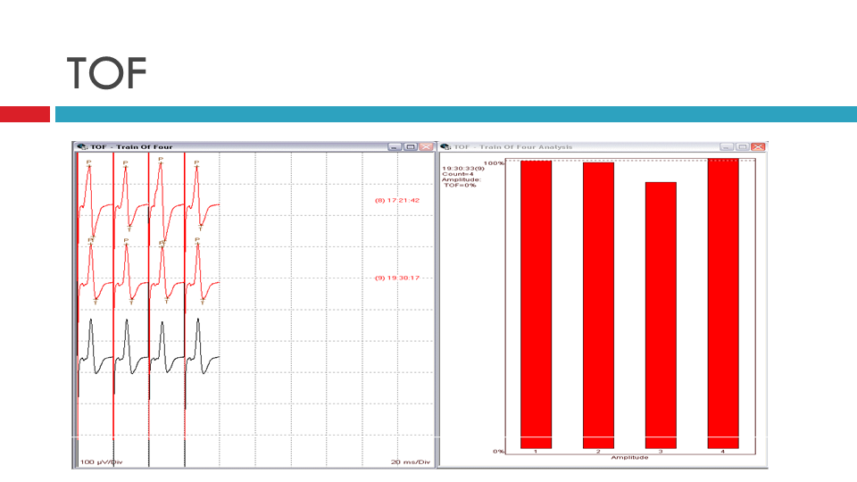 Peripheral Nerve Stimulator - Train of Four Monitoring: Overview,  Periprocedural Care, Technique