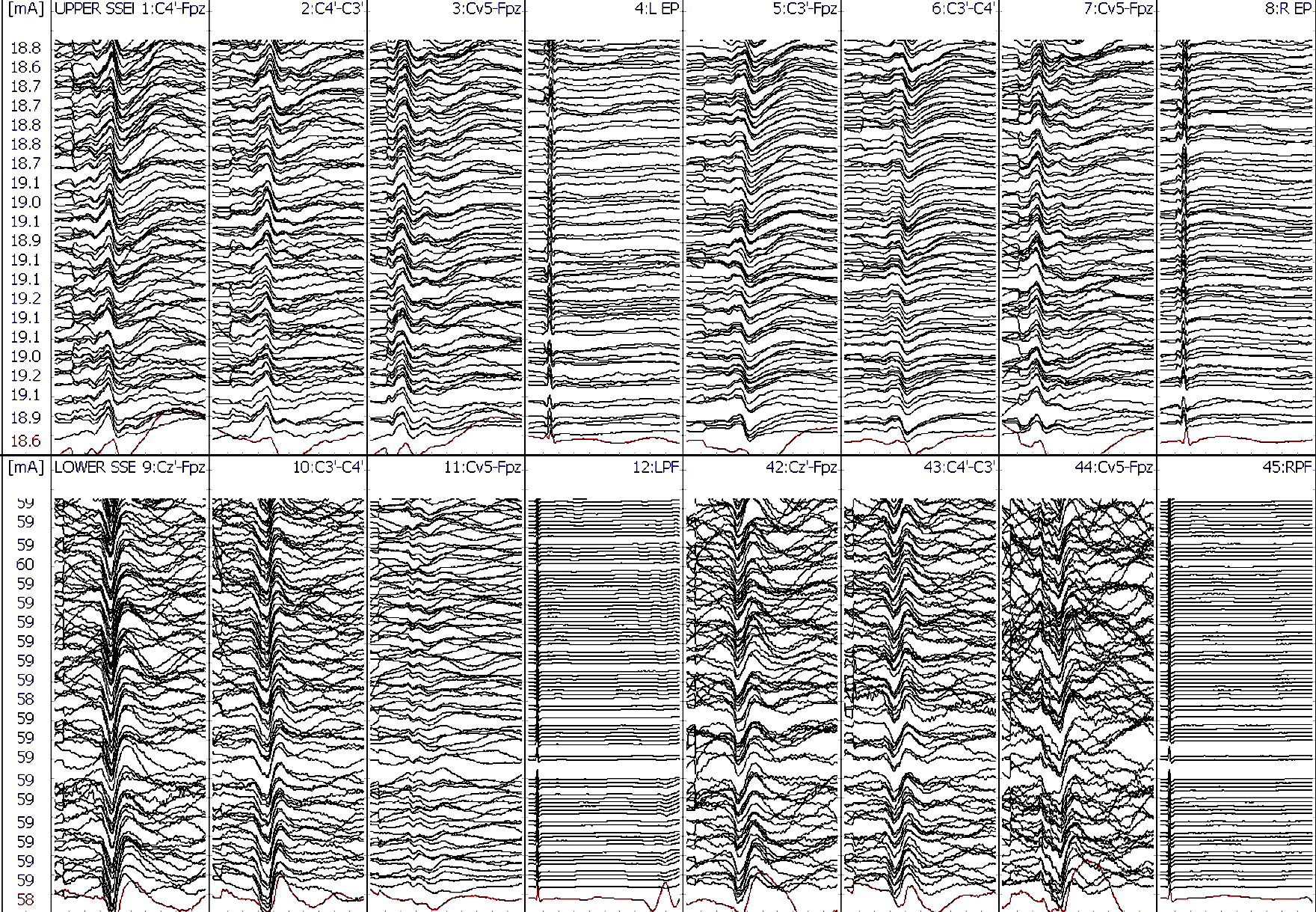 Fig 4. Stage 1 Upper and Lower SSEP Stack