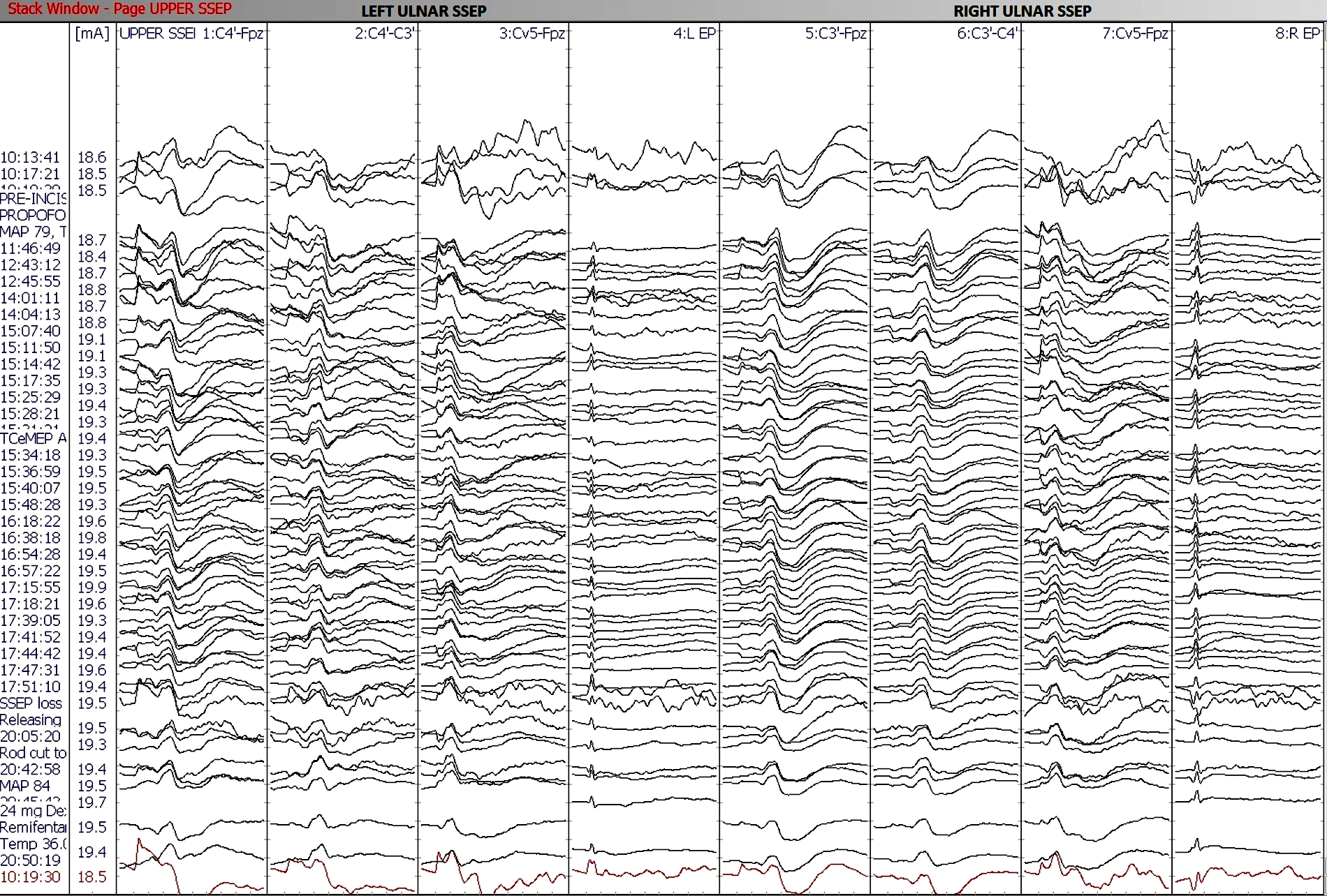 Fig 7. Stage 2. No changes in Upper SSEP