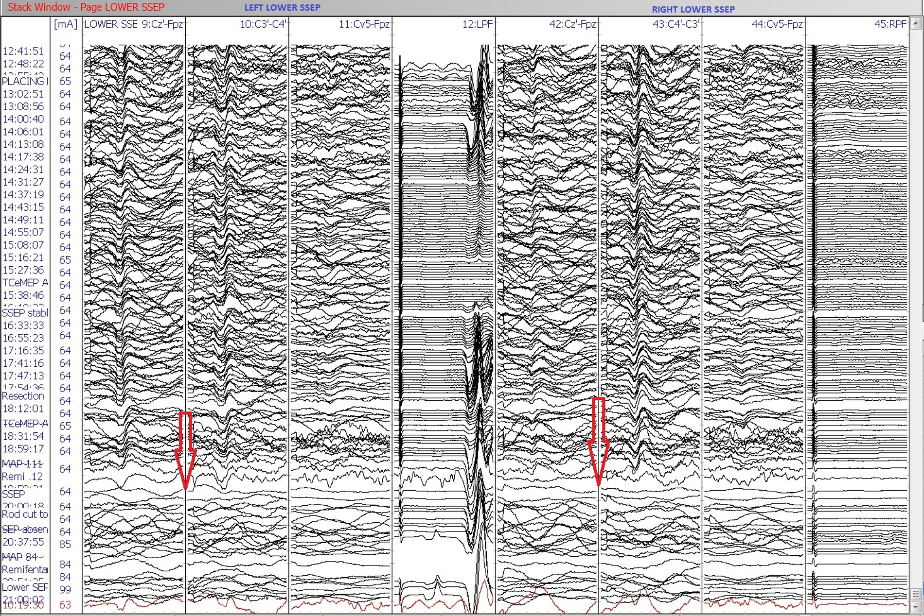 Fig 8. Stage 2 loss of Lower SSEP