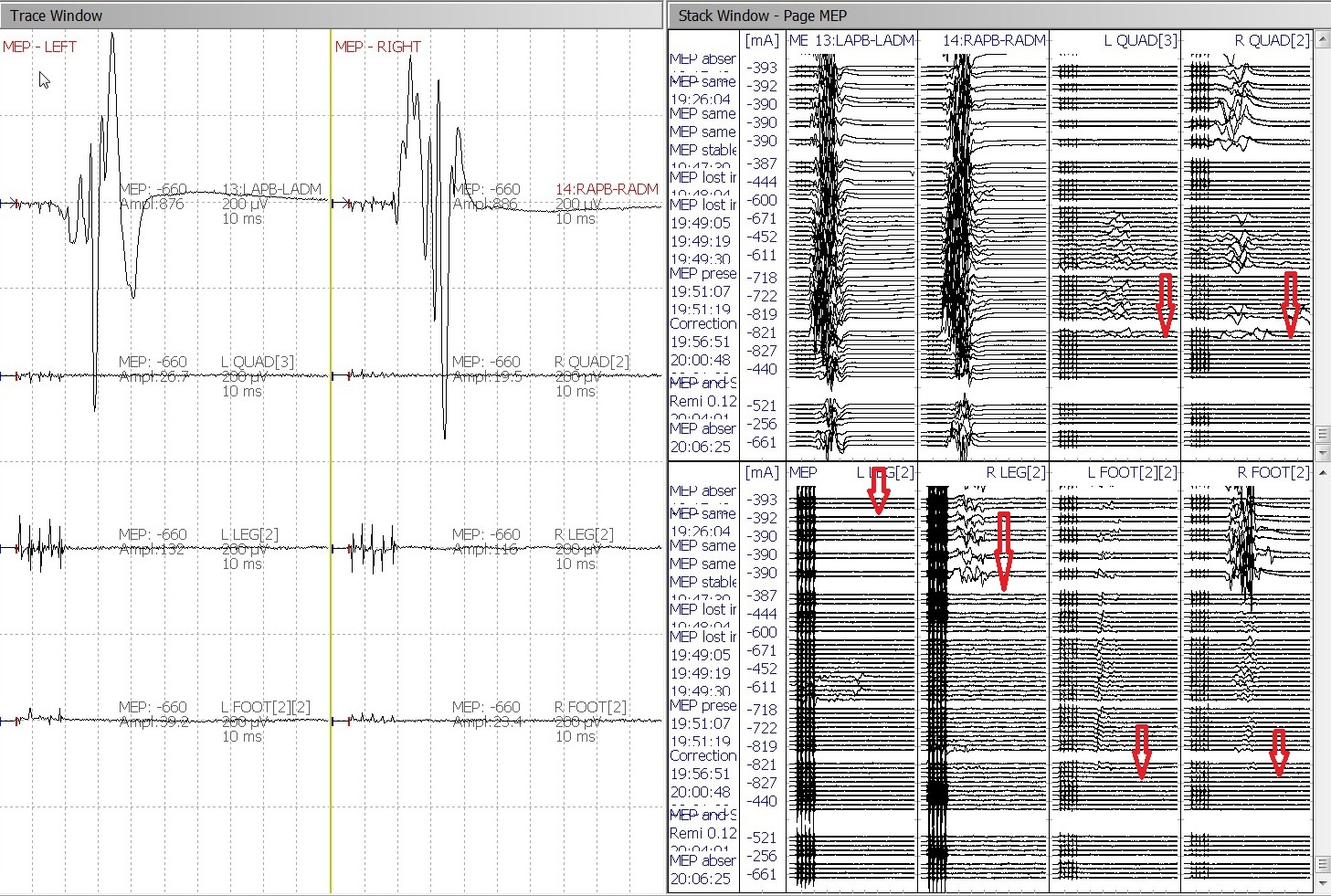 Fig 9. Stage 2 loss of Lower MEP