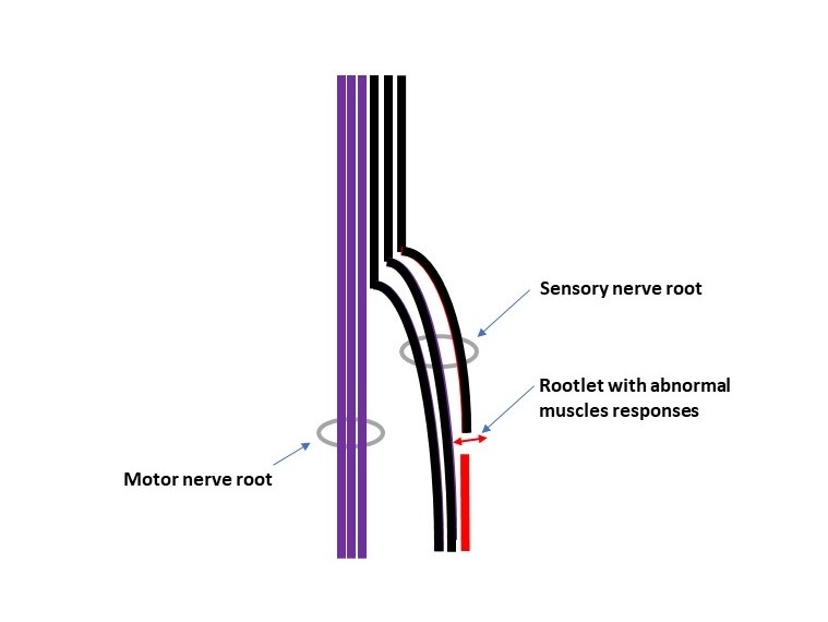 Fig 1. Selective Dorsal Root Rhizotomy (SDR) - Cut Dorsal Rootlet