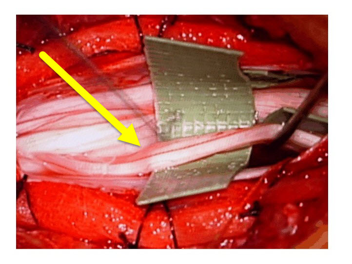 Fig 2. Selective Dorsal Root Rhizotomy (SDR) - Separatlng Dorsal Rootlet