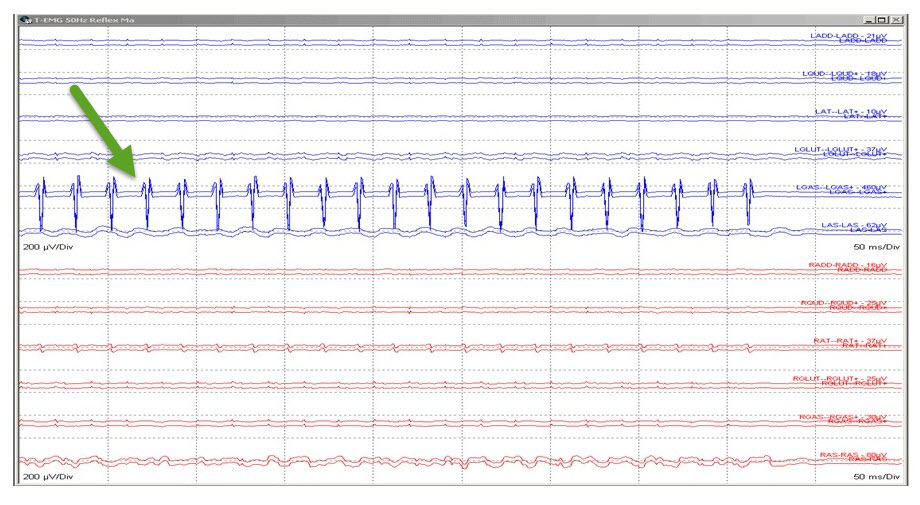 Fig 3. SDR 50 Hz Grade 0 responses