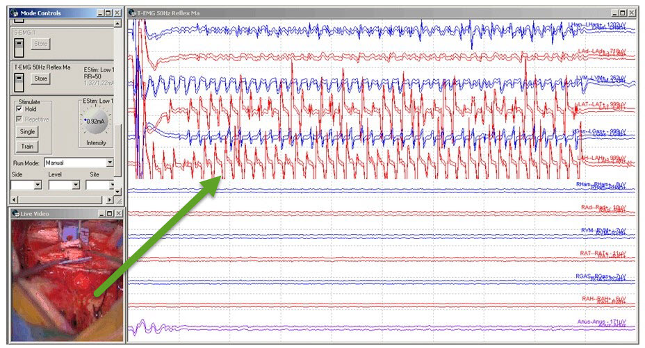 Fig 4. SDR 50 Hz Grade 3 responses